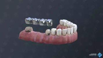 The old teeth's model.
