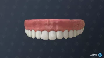 The installed permanent dental bridge for medical 3D video.