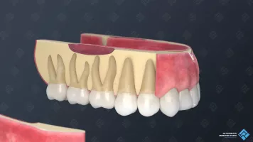 Gerendertes Modell des geschnittenen Zahnfleisches für die 3D-Medizinanimation.