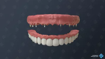 Die permanente Zahnbrücke für medizinische 3D-Videos.