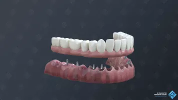 The permanent dental bridge's model.