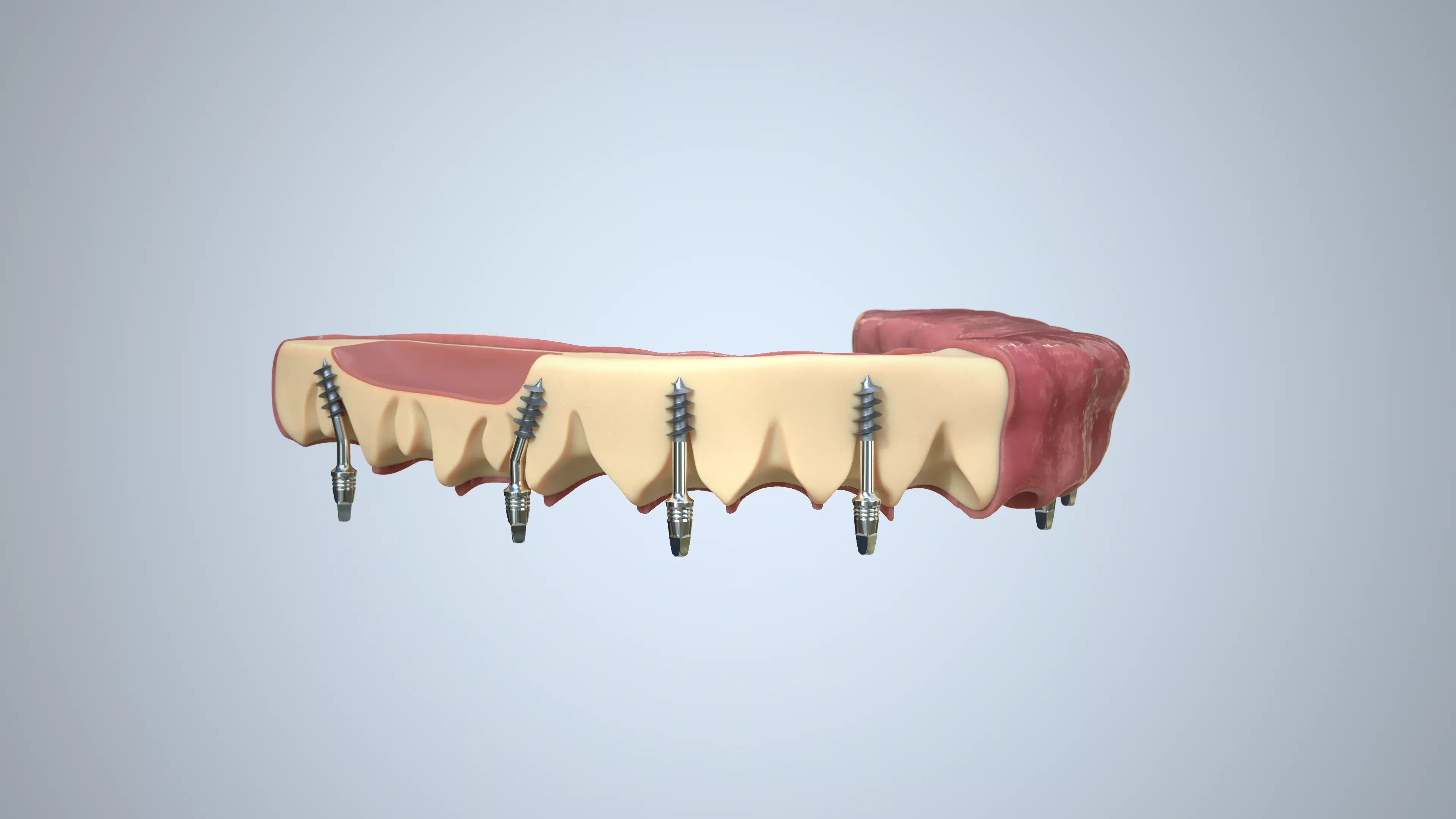 Die Implantate für die medizinische 3D-Animation nach dem Compositing.